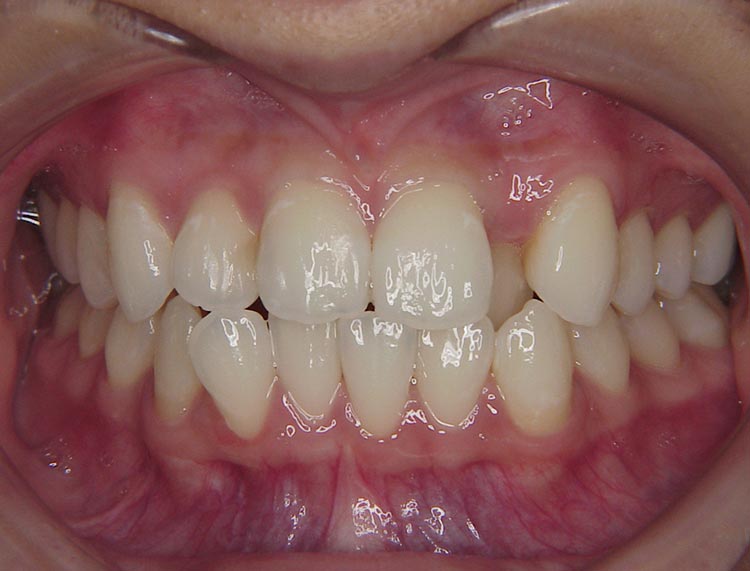 img_medicalguidance_whitening_after